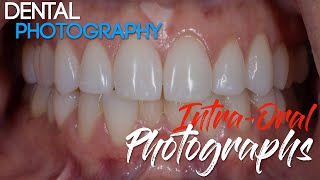 Dental Photography Basics  Dental Photography Techniques  Intraoral Photographs [upl. by Massarelli]