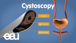 Cystoscopy overactive bladder [upl. by Ilrebmik]