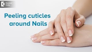 What to do for peeling cuticles around nails  Dr Rasya Dixit  Doctors Circle [upl. by Croom689]