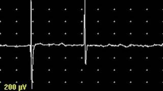 End Plate Spikes [upl. by Conlon]