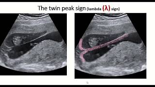 Twin peak sign or lambda sign  feature of dichorionic diamniotic twin pregnancy [upl. by Cutler]