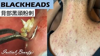 背部黑頭粉刺blackheads on back  Taiwan Tainan台南清粉刺最乾淨 [upl. by Ellette]