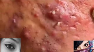 Home Remedy for Treating a Cystic Acne Pimple [upl. by Tneciv]