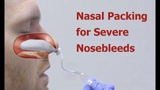 Ear amp Sinus Problems  How Do Nasal Sprays Work [upl. by Schulman]