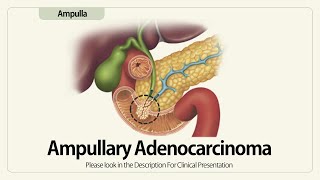 Ampullary Adenocarcinoma [upl. by Aibos421]