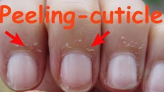 How to care for Skin Peeling near Nails  DIY 4 30days30diy [upl. by Yarod]