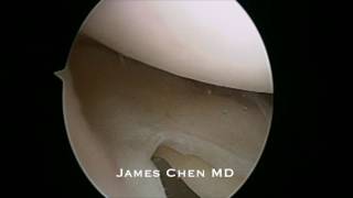 Arthroscopic Saucerization of Discoid Meniscus [upl. by Suirtemed6]