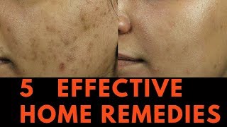 5 EFFECTIVE Home Remedies for Skin Pigmentation Brown Spots and freckles [upl. by Kurland737]