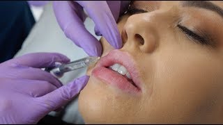 Lip Fillers  what to expect during the procedure  The Laser amp Skin Clinic [upl. by Anyl]