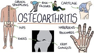 Understanding Osteoarthritis [upl. by Arahahs]