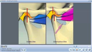 TMJ Disorders [upl. by Atiuqin]