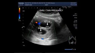 Early first trimester twin Pregnancy  08 weeks [upl. by Aspia]