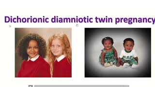 Anatomy of dichorionic and diamniotic twin pregnancy with sonographic feature twin obimagesnet [upl. by Ahsinej]