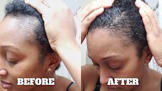 How I Grew My Edges Back Using Wild Growth Hair Oil [upl. by Kaiser464]