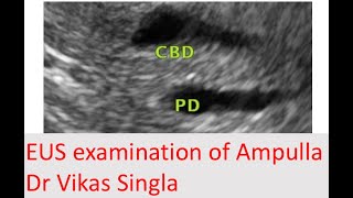 Learning video for EUS EUS examination of Ampulla [upl. by Notsreik1]