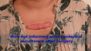 Chest Keloids  Mistakes to Avoid [upl. by Atila957]