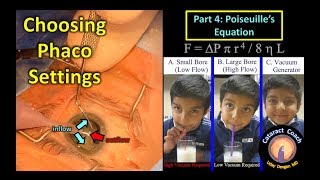 Phaco Fundamentals Part 4 Poiseuilles equation for fluidics in cataract surgery [upl. by Ardath]