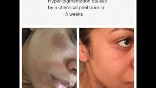 Treating Hyperpigmentation Caused By A Chemical Peel [upl. by Elocin673]