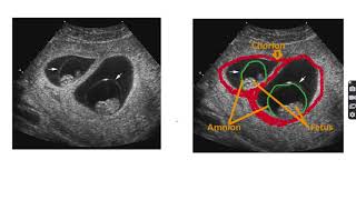 Anatomy of monochorionic diamniotic twin pregnancy twin anatomy pregnancy twinpregnancy [upl. by Wolfgang968]