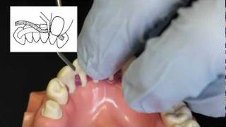 Ribbond Periodontal Splint Technique [upl. by Karalee]