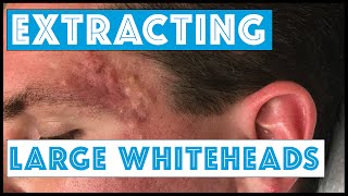 Acne Vulgaris and Extracting large Whiteheads  Part 1 [upl. by Adnamar]