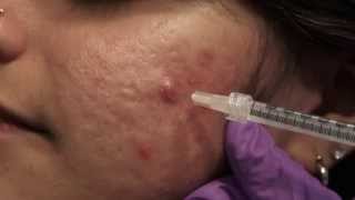 Watch amp Learn Intralesional injections [upl. by Fogarty246]