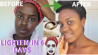 How I How i BRIGHTENED MY SKIN IN 6 DAYS REALISTIC and Natural way to reduce hyperpigmentation [upl. by Christan303]