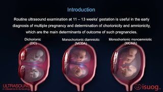 UOG video abstract Outcome of twin pregnancy with two live fetuses at 11–13 weeks’ gestation [upl. by Bremer]