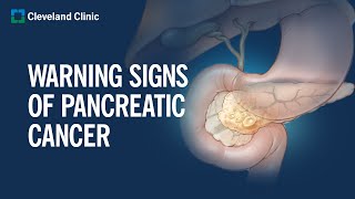 6 Warning Signs of Pancreatic Cancer [upl. by Yrhcaz596]