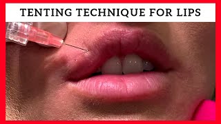 Tenting Technique for Lip Enhancement by Dr Steven F Weiner [upl. by Addison]