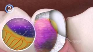 Dental Bonding of Ceramic Inlays [upl. by Animsaj10]