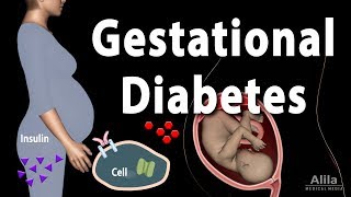 Gestational Diabetes Animation [upl. by Allrud]