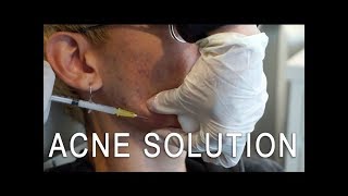 Cystic Acne Solution Kenalog Injection [upl. by Aisac514]