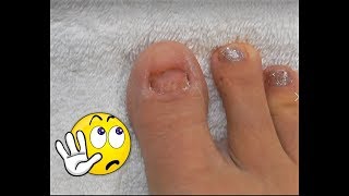 No TOENAILS  Make Some  Acrylic Glitter Toesnails  Using Dual Forms [upl. by Amarillis]