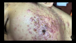 Severe Cystic Acne Infection Treatment Young Age [upl. by Callery]