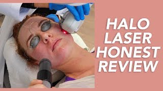 My Halo Laser Experience Honest Review Recovery and Before amp Afters [upl. by Htebazie]