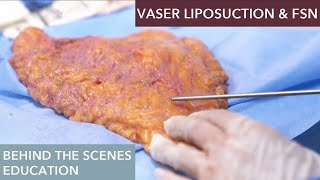 The Science Behind Vaser Liposuction How Does It Work [upl. by Dleifniw]