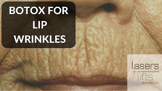 BOTOX for lip wrinkles [upl. by Atsirhcal295]