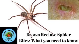 Brown Recluse Spider Bites What you need to know [upl. by Chandra414]