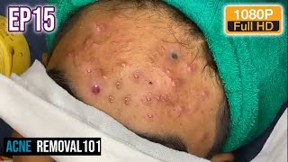 Cystic Acne Extraction 20mn  Acne treatment by ACNEREMOVAL101 [upl. by Oznole]