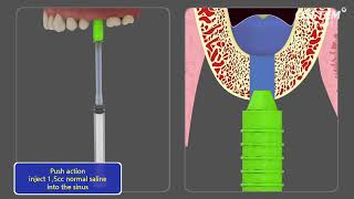 CAS KIT Crestal Approach  Sinus KIT [upl. by Hyacinthie]