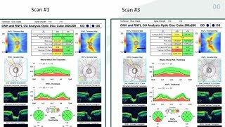 10 Hacks for OCT Interpretation in Glaucoma  Dr Mark Dunbar [upl. by Tebasile]