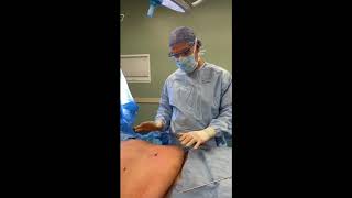 SAFE Liposuction High BMI Patient [upl. by Kerrill633]