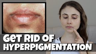 GET RID OF HYPERPIGMENTATION AROUND THE MOUTH DR DRAY [upl. by Myrt]