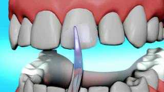 Dental Bonding Video  Tooth Bonding [upl. by Chaim192]