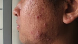 What Is Cystic Acne  Acne Treatment [upl. by Docia]