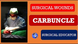 CARBUNCLE How To DIAGNOSE amp TREAT  SURGICAL INFECTIONS [upl. by Lita376]