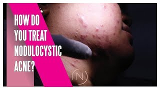 How Do You Treat Nodulocystic Acne  Houston Dermatology [upl. by Eiznekcm982]