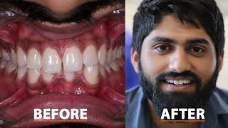 How to close Gap between teeth  Composite Bonding  FMS Dental Hospital  Hyderabad India [upl. by Dowski]