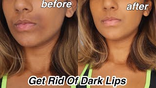 How To Get rid Of Dark Lips And Pigmentation [upl. by Annawoj]